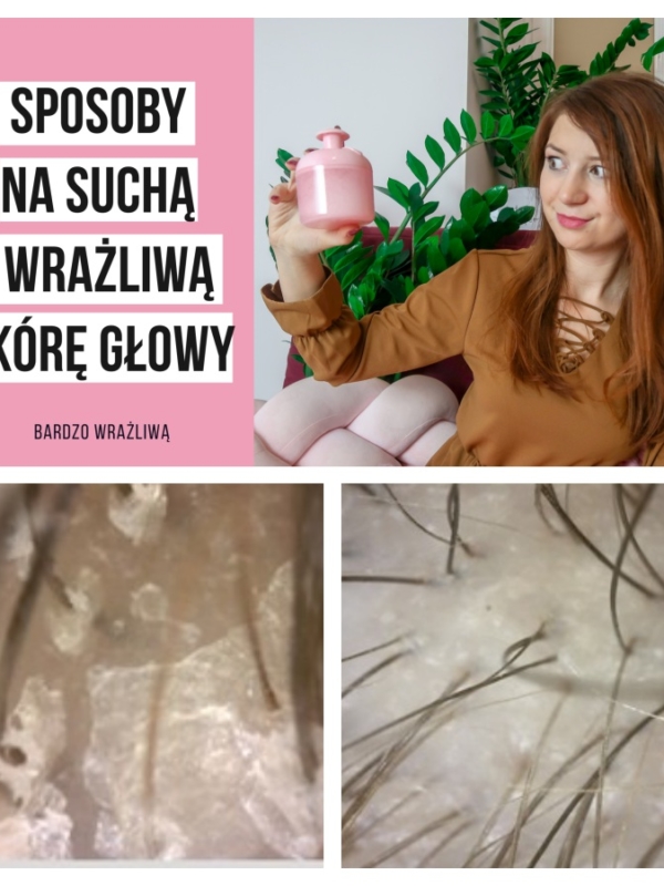 Sposoby na suchą skórę głowy ??