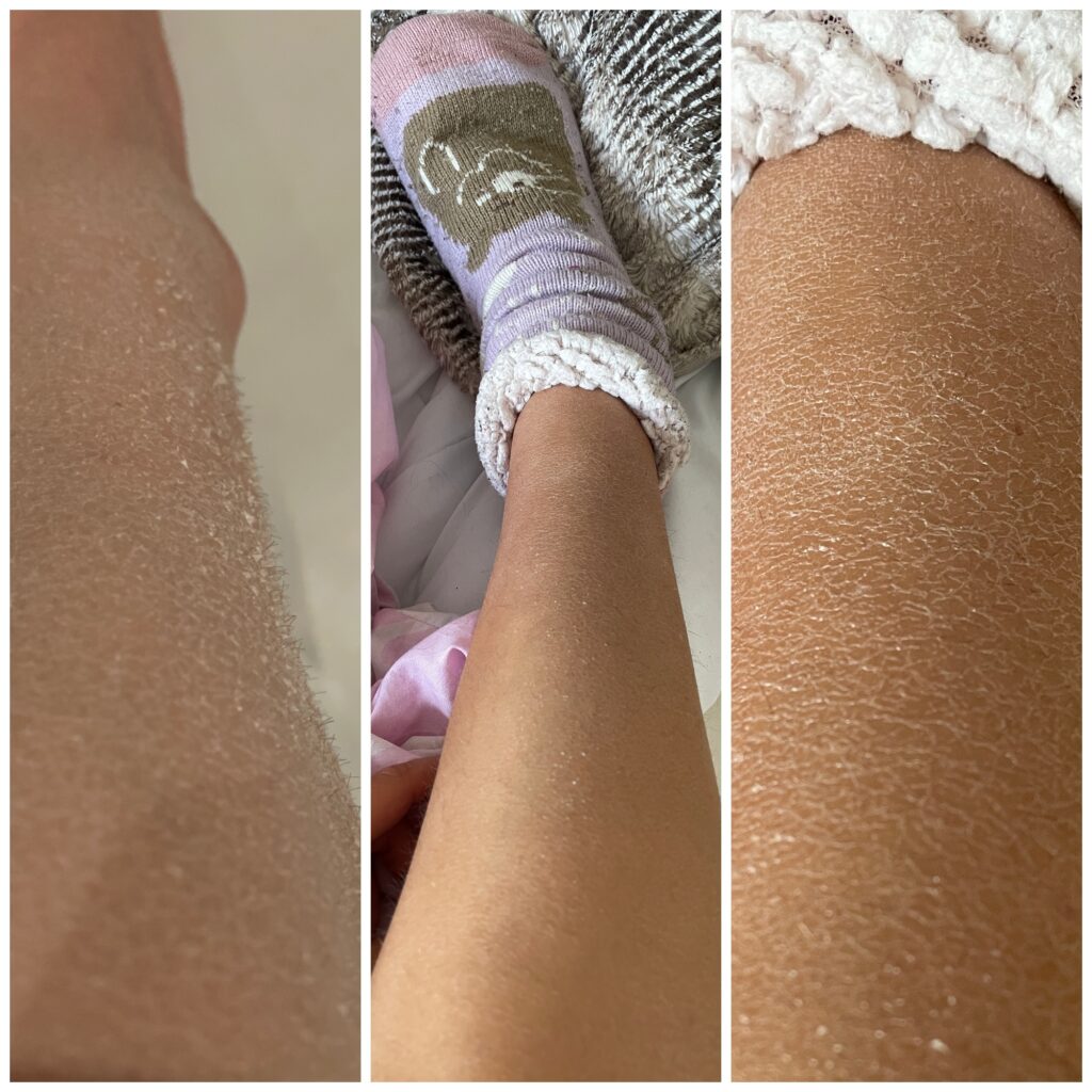 Wrażliwa i sucha skóra - skuteczne i tanie kosmetyki ? SOLVERX